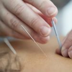 Unlocking Wellness: The Transformative Power of Acupuncture