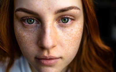 Understanding Acne: Nutrition’s Role in Skin Health and Success