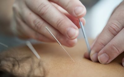 Unlocking Wellness: The Transformative Power of Acupuncture