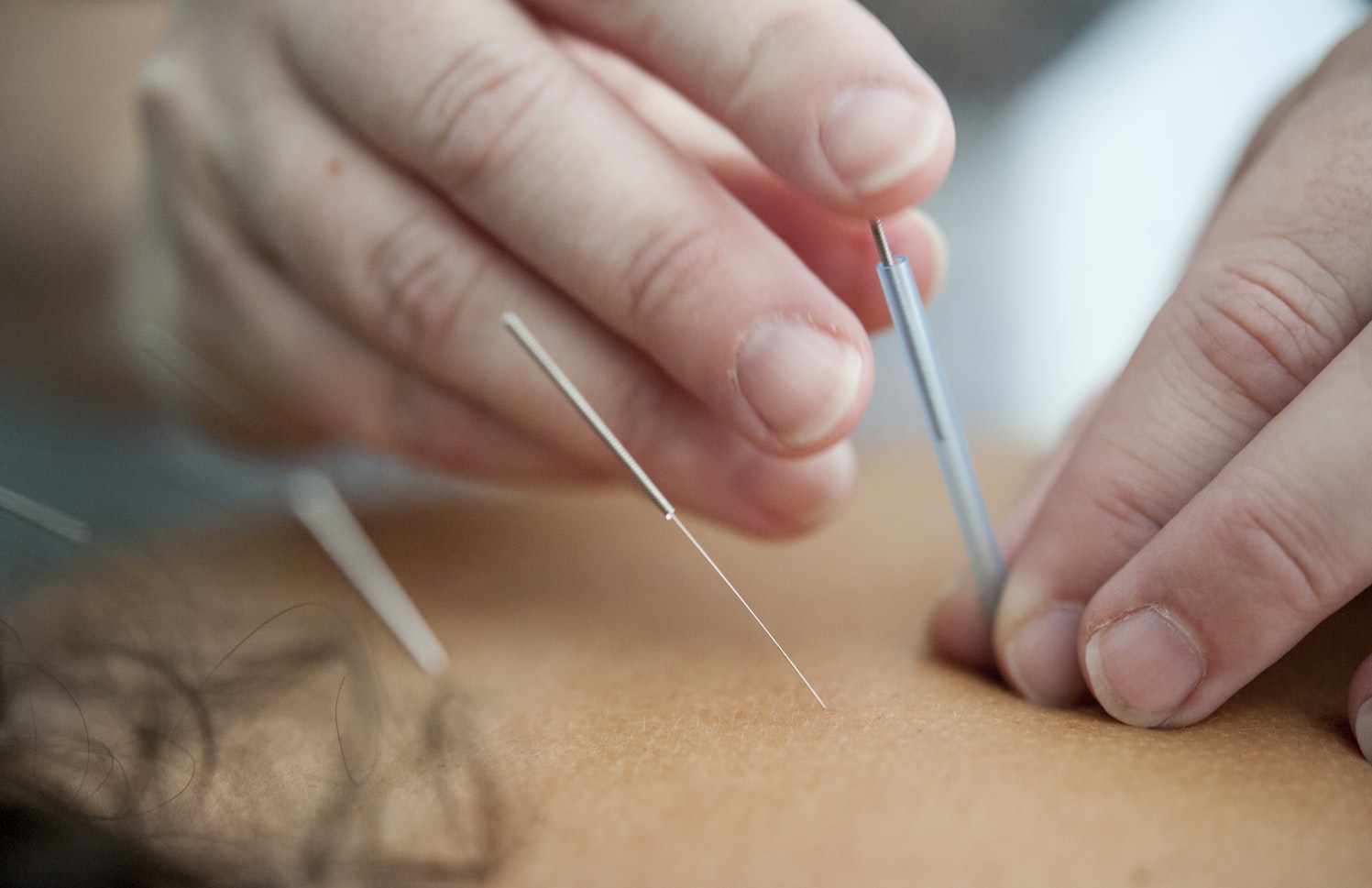 Unlocking Wellness: The Transformative Power of Acupuncture
